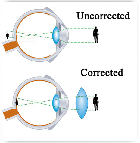 Presbyopia VUITY Eye