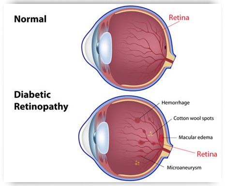 La retinopatía diabética