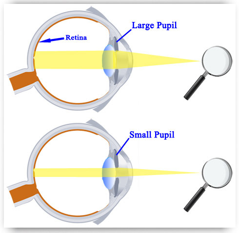 explicando la importantance de dilatación de la pupila