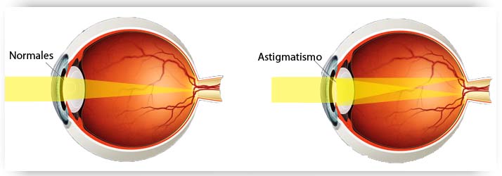 Cómo saber si tengo astigmatismo